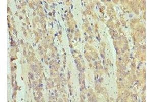 Immunohistochemistry of paraffin-embedded human colon cancer using ABIN7171070 at dilution of 1:100 (SMARCB1 anticorps  (AA 86-385))