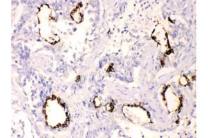 Anterior Gradient 2 was detected in paraffin-embedded sections of  human lung cancer tissues using rabbit anti- Anterior Gradient 2 Antigen Affinity purified polyclonal antibody (Catalog # ) at 1 µg/mL.
