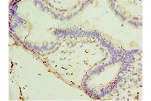 Immunohistochemistry of paraffin-embedded human breast cancer using ABIN7171226 at dilution of 1:100 (Syntaxin 11 anticorps  (AA 1-287))