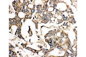 IHC-P: SLC10A1 antibody testing of human liver cancer tissue (SLC10A1 anticorps  (AA 141-154))