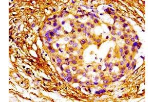Immunohistochemistry of paraffin-embedded human breast cancer using ABIN7160388 at dilution of 1:100