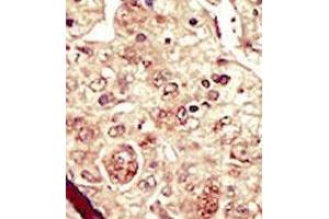 Formalin-fixed and paraffin-embedded human cancer tissue (hepatocarcinoma) reacted with the primary antibody, which was peroxidase-conjugated to the secondary antibody, followed by DAB staining.
