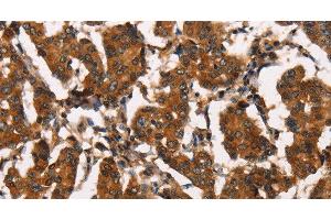 Immunohistochemistry of paraffin-embedded Human breast cancer tissue using ATRN Polyclonal Antibody at dilution 1:50