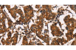 Immunohistochemistry of paraffin-embedded Human breast cancer tissue using ATRN Polyclonal Antibody at dilution 1:50 (Attractin anticorps)