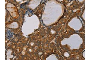The image on the left is immunohistochemistry of paraffin-embedded Human thyroid cancer tissue using ABIN7130527(PAGE2 Antibody) at dilution 1/20, on the right is treated with fusion protein. (PAGE2 anticorps)