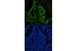 IF analysis of CTBP2 using anti-CTBP2 antibody (ABIN3042768) CTBP2 was detected in paraffin-embedded section of human colon cancer tissues. (CTBP2 anticorps  (AA 321-445))