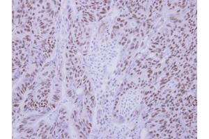 IHC-P Image Immunohistochemical analysis of paraffin-embedded human colon carcinoma, using BS69 antibody, antibody at 1:250 dilution. (ZMYND11 anticorps)