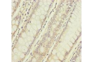 Immunohistochemistry of paraffin-embedded human colon cancer using ABIN7160738 at dilution of 1:100 (NAA25 anticorps  (AA 703-972))