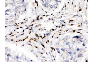 MDMX was detected in paraffin-embedded sections of human lung cancer tissues using rabbit anti- MDMX Antigen Affinity purified polyclonal antibody at 1 μg/mL.