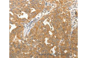 Immunohistochemistry of Human lung cancer using MAP1B  Polyclonal Antibody at dilution of 1:40 (MAP1B anticorps)