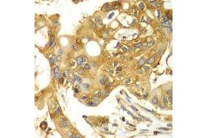 Immunohistochemistry of paraffin-embedded human liver cancer using CAPNS1 antibody. (Calpain S1 anticorps  (AA 69-268))