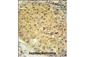 DDC Antibody (N-term) (ABIN651727 and ABIN2840377) immunohistochemistry analysis in formalin fixed and paraffin embedded human hepatocarcinoma followed by peroxidase conjugation of the secondary antibody and DAB staining.