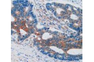 IHC-P analysis of Human Rectum Cancer Tissue, with DAB staining. (VCAM1 anticorps  (AA 109-318))