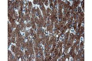 Immunohistochemical staining of paraffin-embedded Adenocarcinoma of endometrium tissue using anti-FAHD2A mouse monoclonal antibody. (FAHD2A anticorps)