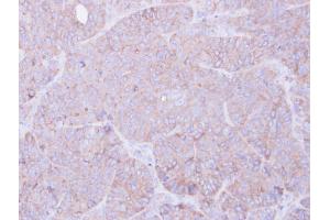 IHC-P Image Immunohistochemical analysis of paraffin-embedded SW480 xenograft, using RAGE, antibody at 1:100 dilution.
