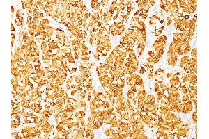 Formalin-fixed, paraffin-embedded human Melanoma stained with Melan-A / MART-1 Mouse Monoclonal Antibody (DT101 + BC199). (MLANA anticorps)