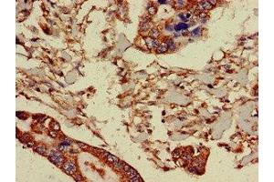 Immunohistochemistry of paraffin-embedded human pancreatic cancer using ABIN7164763 at dilution of 1:100 (PRR11 anticorps  (AA 1-360))