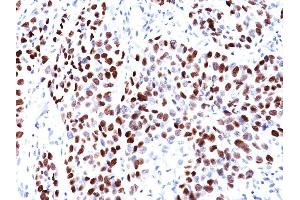 Formalin-fixed, paraffin-embedded human Lung SqCC stained with p21 Mouse Monoclonal Antibody (CIP1/823). (p21 anticorps)