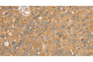 Immunohistochemistry of paraffin-embedded Human breast cancer using SNX2 Polyclonal Antibody at dilution of 1:40
