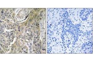 Immunohistochemistry analysis of paraffin-embedded human lung carcinoma tissue, using RHOBTB3 Antibody. (RHOBTB3 anticorps  (AA 335-384))
