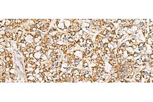 Immunohistochemistry of paraffin-embedded Human liver cancer tissue using ISOC2 Polyclonal Antibody at dilution of 1:95(x200) (ISOC2 anticorps)