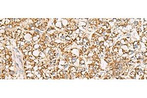 Immunohistochemistry of paraffin-embedded Human liver cancer tissue using ISOC2 Polyclonal Antibody at dilution of 1:95(x200)