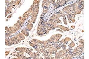 The image on the left is immunohistochemistry of paraffin-embedded Human esophagus cancer tissue using ABIN7127988(PPIL1 Antibody) at dilution 1/30, on the right is treated with fusion protein. (PPIL1 anticorps)
