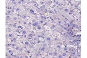 ABIN6267483 at 1/200 staining human liver cancer tissue sections by IHC-P. (IRS1 anticorps  (pSer307))