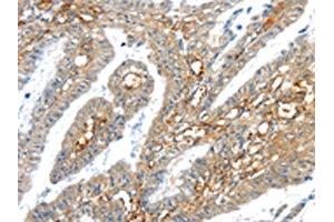 The image on the left is immunohistochemistry of paraffin-embedded Human esophagus cancer tissue using ABIN7192909(TRIM47 Antibody) at dilution 1/30, on the right is treated with synthetic peptide. (TRIM47 anticorps)