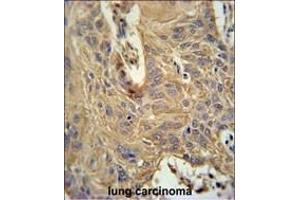 IL5RA Antibody (N-term) (ABIN651428 and ABIN2840234) immunohistochemistry analysis in formalin fixed and paraffin embedded human lung carcinoma followed by peroxidase conjugation of the secondary antibody and DAB staining. (IL5RA anticorps  (N-Term))