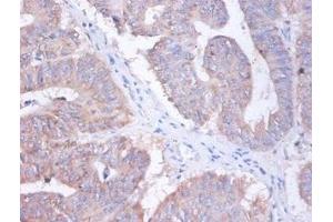 Immunohistochemistry of paraffin-embedded human colon cancer using ABIN7144373 at dilution of 1:100
