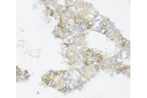 Immunohistochemistry of paraffin-embedded Human mammary cancer using BCL2L2 Polyclonal Antibody at dilution of 1:100 (40x lens).