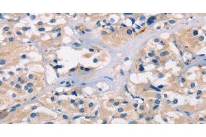 Immunohistochemistry of paraffin-embedded Human thyroid cancer tissue using ADGRB1 Polyclonal Antibody at dilution 1:40 (ADGRB1 anticorps)