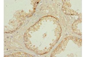 Immunohistochemistry of paraffin-embedded human prostate cancer using ABIN7146273 at dilution of 1:100 (Calcineurin B anticorps  (AA 1-170))