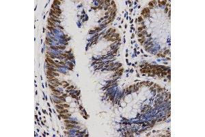 Immunohistochemistry of paraffin-embedded human rectal cancer tissue using PELP1 antibody at dilution of 1:200 (x400 lens). (PELP1 anticorps  (AA 1021-1180))