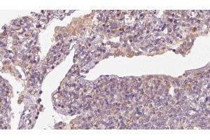 ABIN6273163 at 1/100 staining Human lymph cancer tissue by IHC-P.