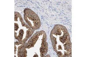 Immunohistochemical staining (Formalin-fixed paraffin-embedded sections) of human prostate with C3orf39 polyclonal antibody  shows strong cytoplasmic positivity in glandular cells. (C3orf39 anticorps)