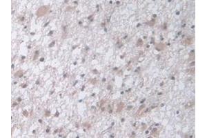 Detection of PCI in Human Glioma Tissue using Polyclonal Antibody to Protein C Inhibitor (PCI)