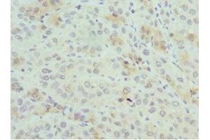 Immunohistochemistry of paraffin-embedded human liver cancer using ABIN7164913 at dilution of 1:100