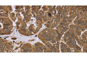 Immunohistochemistry of paraffin-embedded Human ovarian cancer tissue using IKBIP Polyclonal Antibody at dilution 1:40 (IKbIP anticorps)