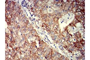 Immunohistochemical analysis of paraffin-embedded stomach cancer tissues using CD104 mouse mAb with DAB staining.