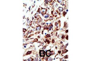 Formalin-fixed and paraffin-embedded human cancer tissue reacted with STAM polyclonal antibody  , which was peroxidase-conjugated to the secondary antibody, followed by AEC staining. (STAM anticorps  (C-Term))