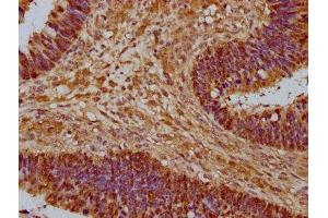IHC image of ABIN7142105 diluted at 1:1000 and staining in paraffin-embedded human ovarian cancer performed on a Leica BondTM system.