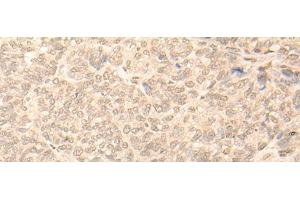 Immunohistochemistry of paraffin-embedded Human ovarian cancer tissue using NARF Polyclonal Antibody at dilution of 1:45(x200) (NARF anticorps)