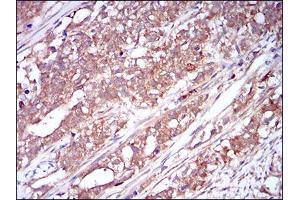 Immunohistochemical analysis of paraffin-embedded cervical cancer tissues using CSF1R mouse mAb with DAB staining. (CSF1R anticorps  (AA 344-497))