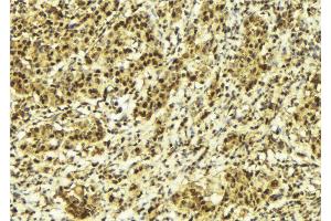 ABIN6273140 at 1/100 staining Human breast cancer tissue by IHC-P. (MLXIP anticorps  (N-Term))
