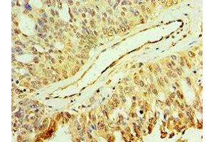 Immunohistochemistry of paraffin-embedded human endometrial cancer using ABIN7150705 at dilution of 1:100
