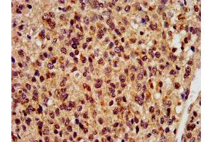 IHC image of ABIN7168275 diluted at 1:400 and staining in paraffin-embedded human glioma performed on a Leica BondTM system.