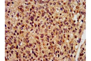IHC image of ABIN7168275 diluted at 1:400 and staining in paraffin-embedded human glioma performed on a Leica BondTM system. (RBM9 anticorps  (AA 8-110))