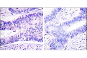 Immunohistochemistry analysis of paraffin-embedded human colon carcinoma, using WAVE1 (Phospho-Tyr125) Antibody. (WASF1 anticorps  (pTyr125))